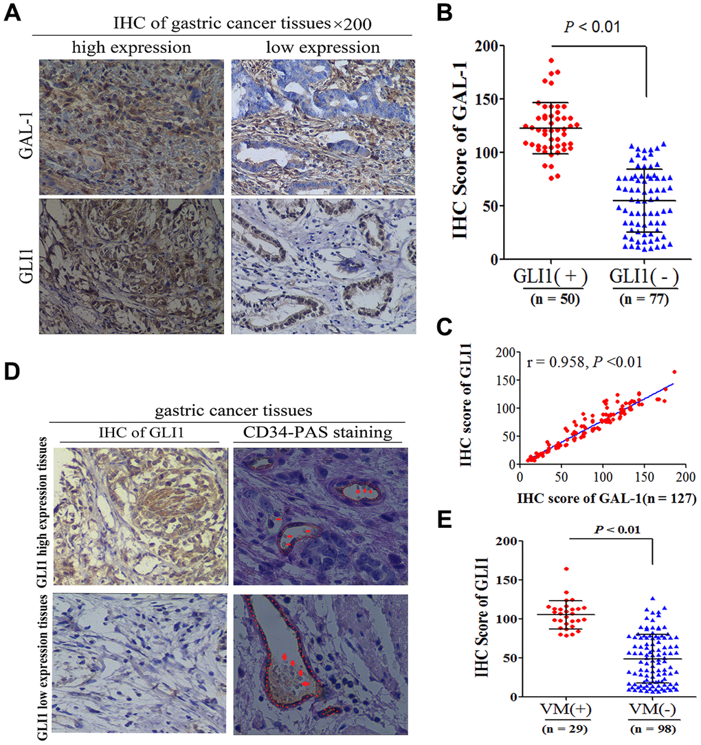 Galectin-1 promotes vasculogenic mimicry in gastric adenocarcinoma 