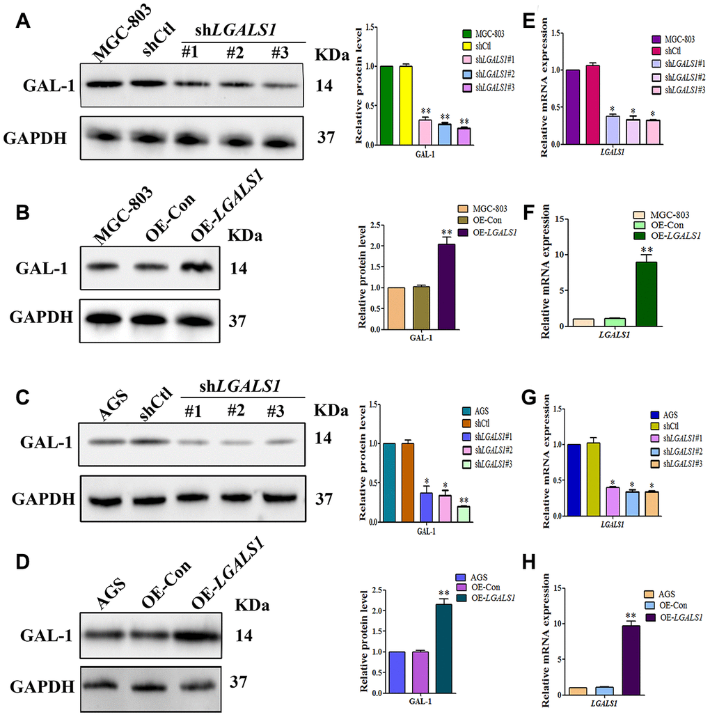 Galectin-1 promotes vasculogenic mimicry in gastric adenocarcinoma 