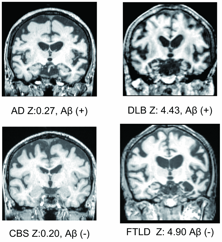 Representative medial temporal lobe images, VSRAD Z scores, and amyloid positivity.