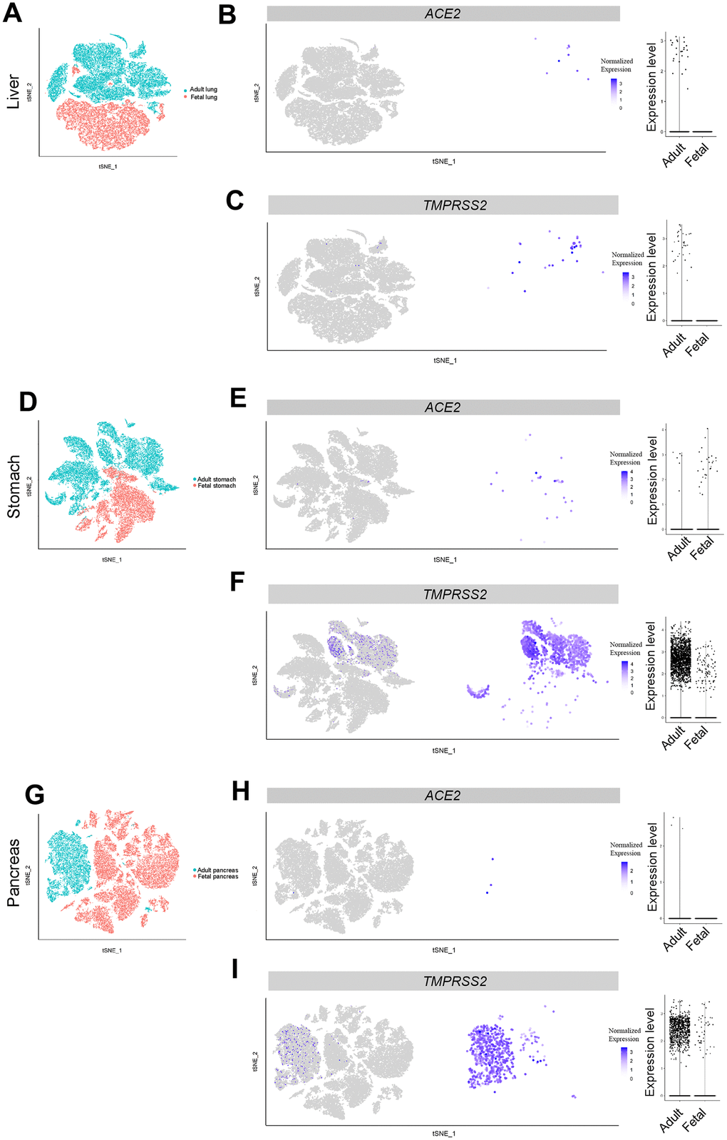 Single-cell analysis of liver, pancreas and stomach. (A) t-distributed stochastic neighbor embedding (TSNE) plot showing sub-clusters of liver cells, (B) ACE2 and (C) TMPRSS2 expression in liver from the adult and fetal groups. (D) TSNE plot showing sub-clusters of stomach cells, (E) ACE2 and (F) TMPRSS2 expression in stomach from the adult and fetal groups. (G) TSNE plot showing sub-clusters of pancreas cells, (H) ACE2 and (I) TMPRSS2 expression in pancreas from the adult and fetal groups.
