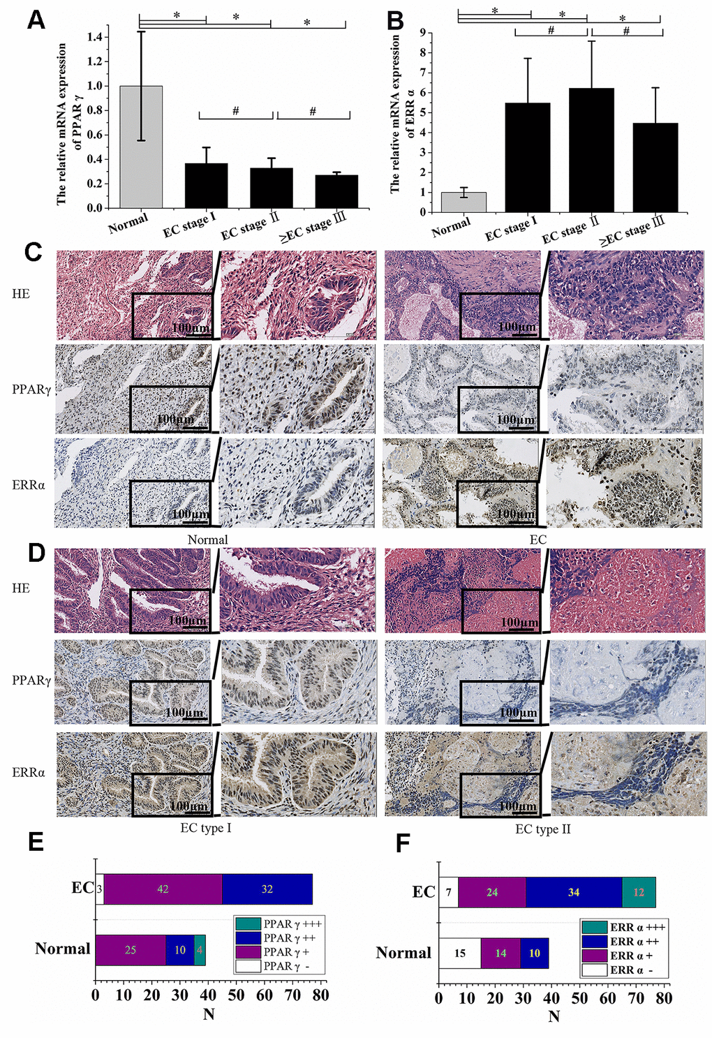 PPARγ was negatively correlated with ERRα in EC tissue. (A) The relative mRNA expression of PPARγ and (B) the relative mRNA expression of ERRα in EC patients with different FIGO stages. (C) Immunohistochemical expression of PPARγ and ERRα in the normal endometrium and EC (×200 & ×400). (D) Immunohistochemical expression of PPARγ and ERRα in EC type I and EC type II (×200 & ×400). (E) Immunohistochemical expression of PPARγ in the normal endometrium and EC. (F) Immunohistochemical expression of ERRα in the normal endometrium and EC. CON: normal endometrium. EC, endometrial cancer. *, P0.05.