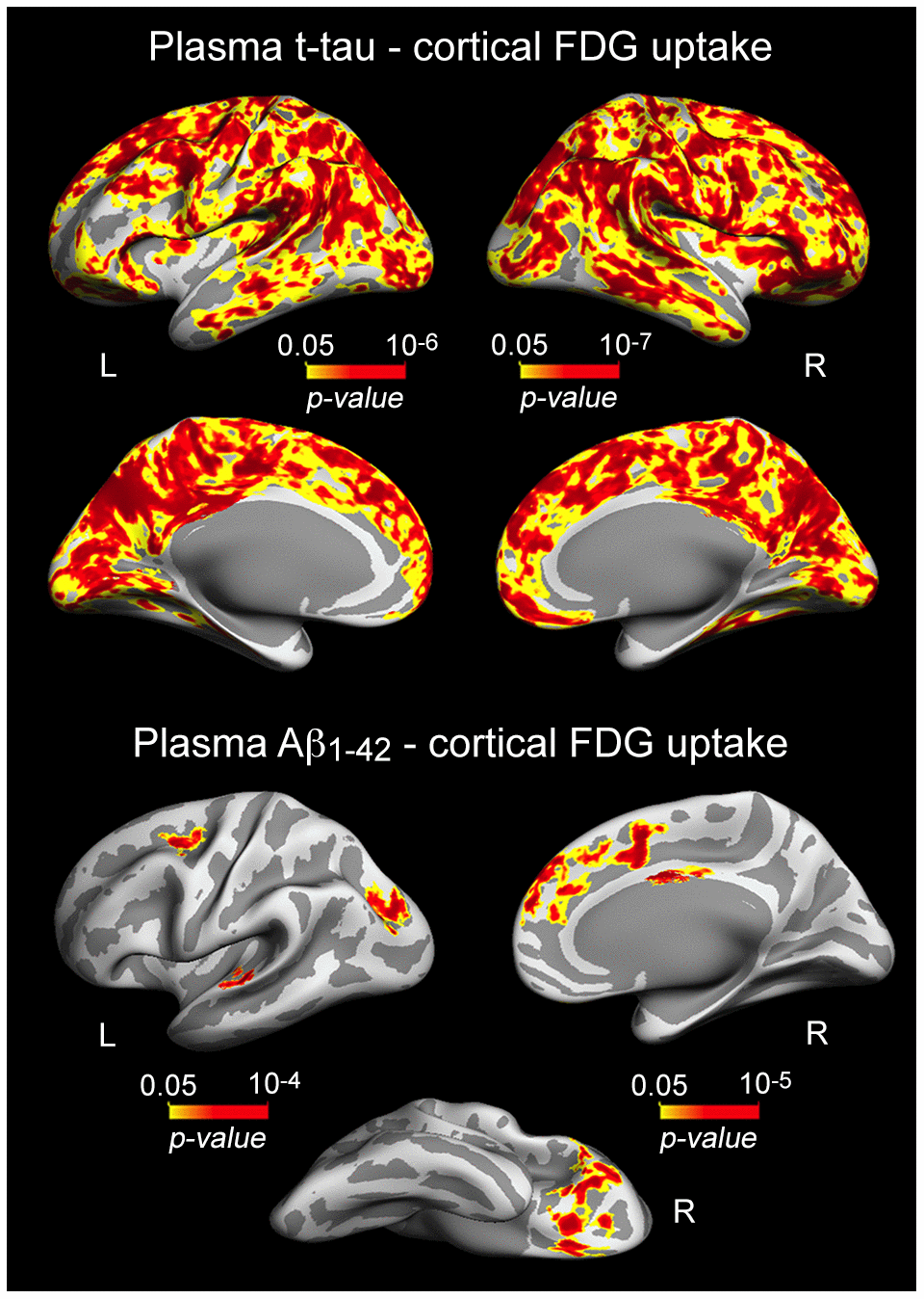 Significant associations between increased plasma t-tau/Aβ1-42 and lower cortical FDG uptake. Results are represented on inflated cortical surfaces. Left (L) and right (R). The color scale bar illustrates the range of significant p-values.