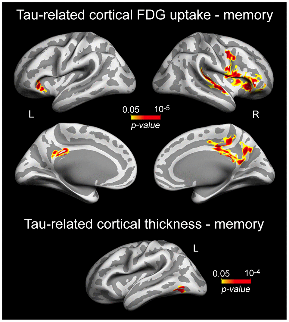 Significant associations between plasma t-tau-related reductions of cortical FDG uptake/cortical thinning and memory performance. Results are represented on inflated cortical surfaces. Left (L) and right (R). The color scale bar illustrates the range of significant p-values.