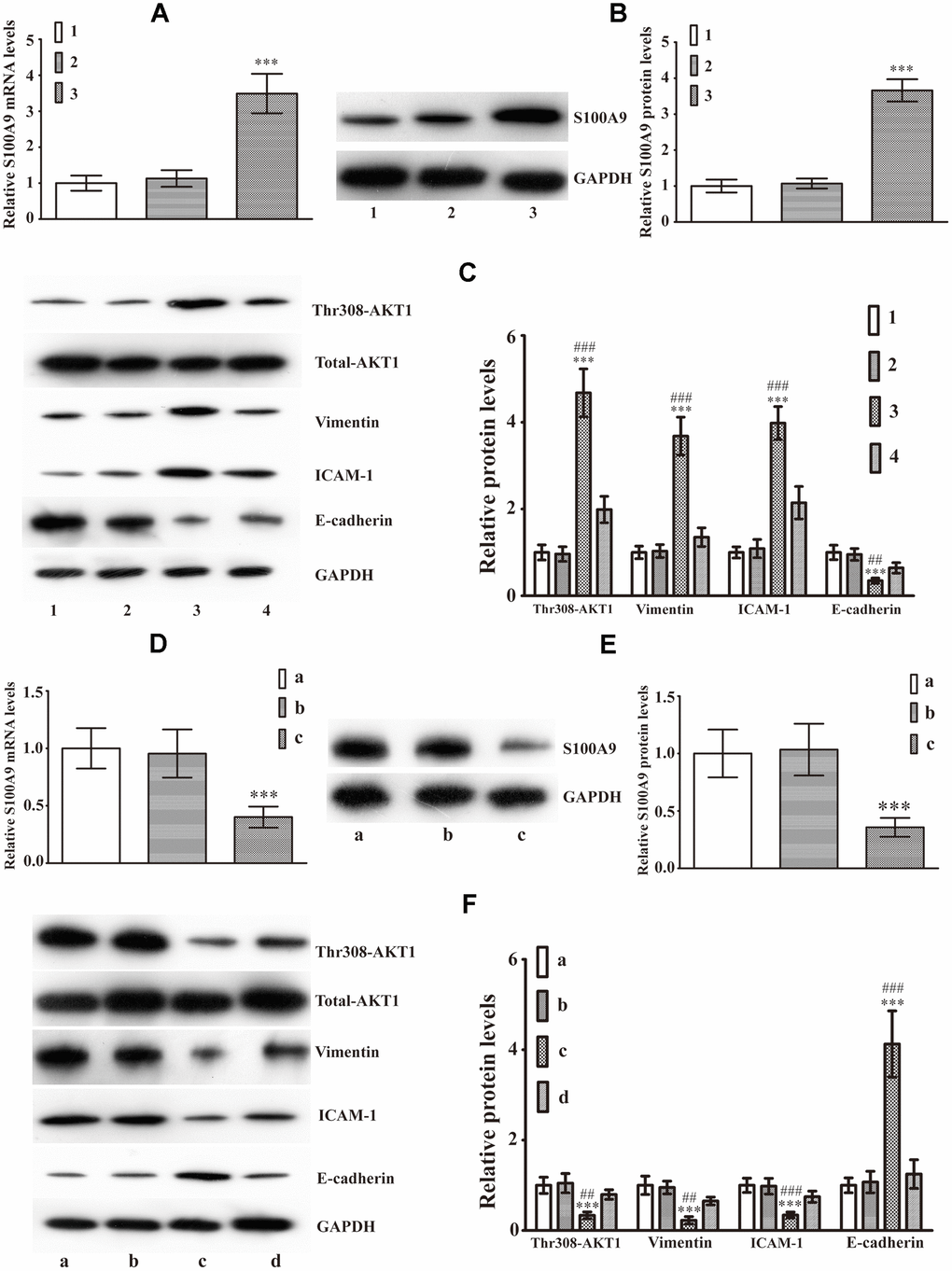 Intracellular S100A9 regulates phosphorylation of AKT1Thr308 and induces EMT in PA. (A) The mRNA levels of S100A9 in control group (group 1), NC1 group (group 2), LV-S100A9 group (group 3) were detected by Real-Time PCR(n=9, P***B) Western blot was used to observe S100A9 protein levels in groups 1, 2, and 3(n=5, P***C) The expression of phospho-AKT1Thr308, Vimentin, ICAM-1 and E-cadherin was explored using western blot analysis in groups 1, 2, 3 and a LV-S100A9 + addition of A-674563 group (group 4)(n=5, P***vs. group 1. P##P###vs. group 4). (D, E) Real-time PCR and western blot analysis were used to investigate S100A9 mRNA and protein expression in the control group (group a), NC2 group (group b) and S100A9-shRNA-LV group (group c), respectively(n=5, P***F) Western blot demonstrated that downregulation of S100A9 reduced phospho-AKT1Thr308, Vimentin, ICAM-1, coupled with increase in E-cadherin. The S100A9-shRNA-LV + SC79(AKT1 agonist) group (group d) displayed that the reduced phospho-AKT1Thr308, Vimentin, ICAM-1 and elevated E-cadherin were reversed partially by SC97(n=5. P***