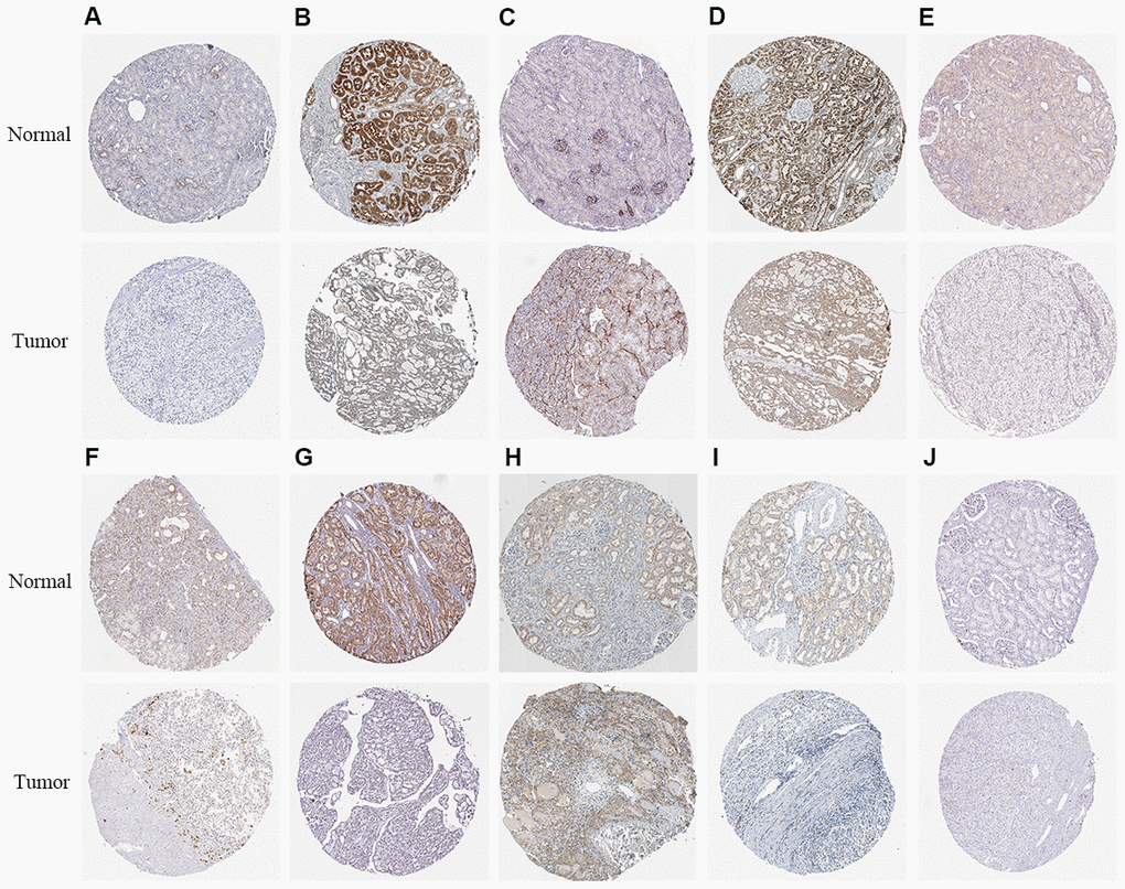 The expression status of the prognosis related metabolic proteins in ccRCC and normal renal tissues in the HPA database. (A) NOS1; (B) ALAD; (C) ALDH3B2; (D) ACADM; (E) ITPKA; (F) IMPDH1; (G) SCD5; (H) FADS2; (I) CA4; (J) HK3.