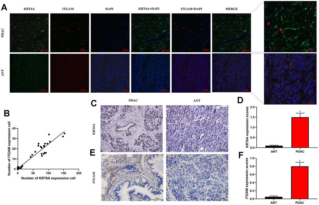 Immunofluorescence and immunohistochemistry (IHC) staining by integrating KRT6A and ITGAM expression. (A) Immunofluorescence staining of KRT6A (green) and ITGAM (red) in PDAC and ANT frozen tissue sections (100×). (B) Pearson's correlation of KRT6A and ITGAM expressing cells in PDAC and ANT. (C–F) IHC staining of KRT6A (c) and ITGAM (e) in PDAC and ANT (200×). Column charts were shown in (D) for KRT6A and (F) for ITGAM. *p