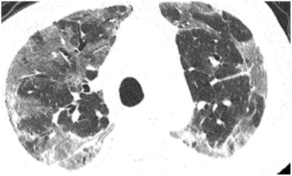 Case 4, flaky or frosted glass like- high-density shadow in both lungs.