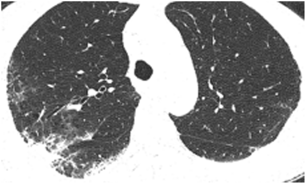 Case 5, focal high-density shadow in right lung.