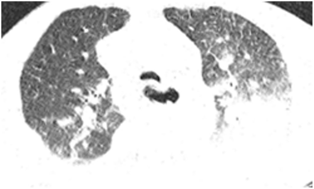 Case 6, flaky or frosted glass like- high-density shadow in both lungs with pleural effusion in left lung.