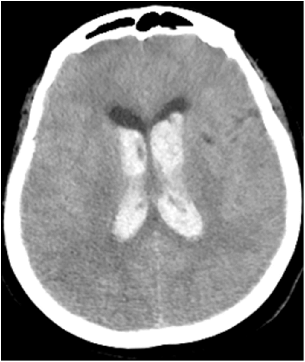 Case 3, head CT imaging: one patient had brainstem hemorrhage with ventricular cast and hydrocephalus.
