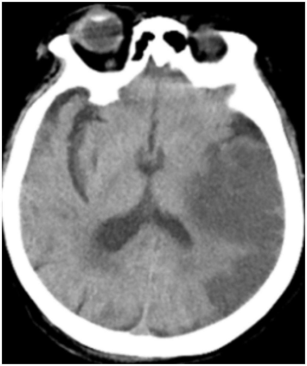 Case 2, a large area of uniform low-density shadow on the left frontotemporal lobe.