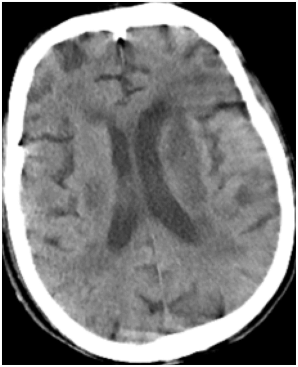 Case 6 multiple flaky low-density shadow on the parietal lobe.