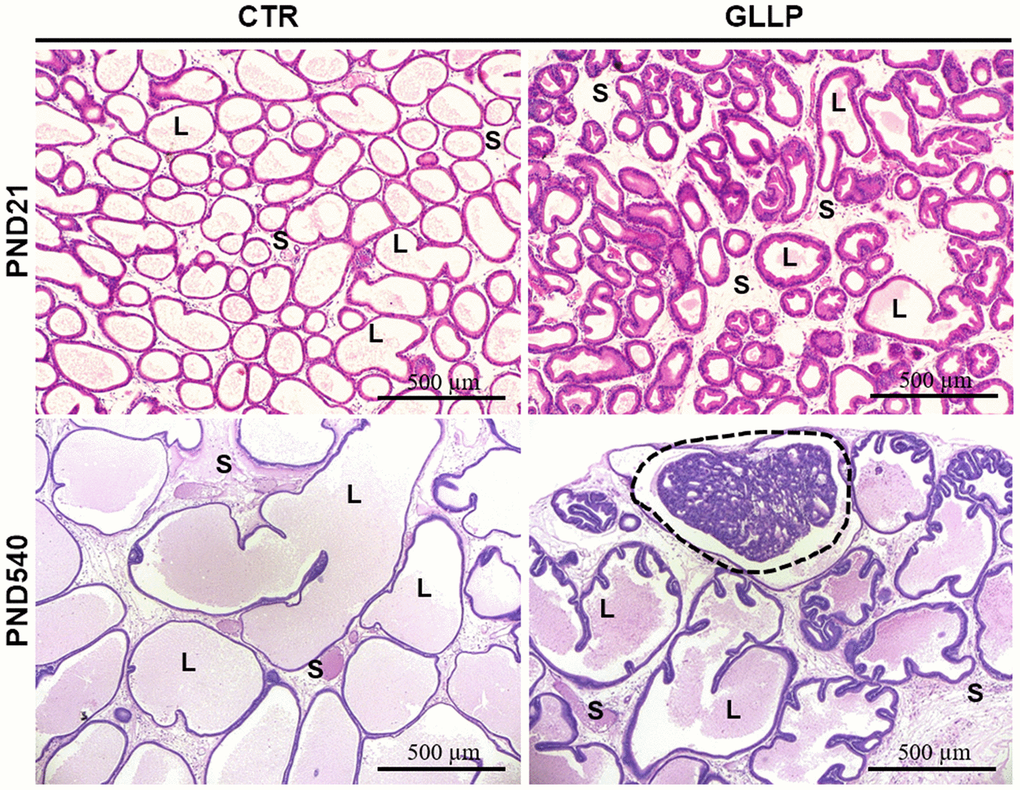 Representative histological sections of the VP lobes from the CTR and GLLP groups on PND 21 and 540, stained with hematoxylin-eosin (HE). Glandular growth in the GLLP group on PND 21 was impaired compared to the CTR. At PND 540, the carcinoma in situ was highlighted by the dashed circle. S = Stroma, L = Lumen, E = Epithelium, Scale bar: 500 μm.