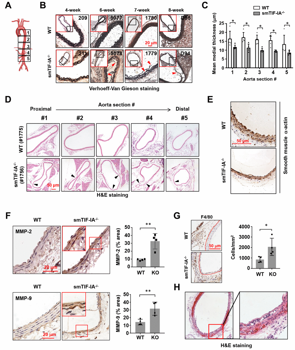 Smooth muscle-specific nucleolar stress induction by TIF-IA deletion (smTIF-IA-/-) resulted in aneurysm-like lesions in the aorta. (A) Depiction of sampling locations along the aorta for histopathological examinations. The aorta was divided into five parts from the proximal to the distal end. (B) Representative images of Verhoeff-Van Gieson staining of abdominal aortas (section #4 as shown in A) from sex-matched littermate wild type (WT) and smTIF-IA-/- animals of different age. The red-outlined insets were low power images indicating the area where the corresponding high power images were taken. Sites with elastic laminar derangements were indicated by arrowheads. Animal identification tag numbers were shown at the top right corner. (C) Changes in the mean medial thickness of smTIF-IA-/- aorta as compared to WT controls (n = 5). (D) H&E staining images showing multiple aneurysm-like lesions (arrowheads) throughout a single aorta from smTIF-IA-/- animal. (E) Immunohistochemical staining for smooth muscle α-actin (brown color) showing diminished smooth muscle cells in smTIF-IA-/- aorta. (F) Immunohistochemical staining (brown color) and semi-quantitative data showing the increased levels of matrix metalloproteinase (MMP)-2 and MMP-9 in smTIF-IA-/- (KO) aorta (n = 4). High power images were shown in red boxes. (G) F4/80 staining and quantitative data showing increased accumulation of macrophages in smTIF-IA-/- abdominal aorta (n = 4). Dashed lines indicated the media-adventitia border. (H) Low and high power images of the abdominal aorta from one smTIF-IA-/- animal sacrificed alive at 9 weeks showing abundant intramural red blood cells (H&E staining), indicating the presence of aortic dissection. Quantitative data were expressed as dot blot-combined bar graphs representing mean ± S.D. * P P t-test.