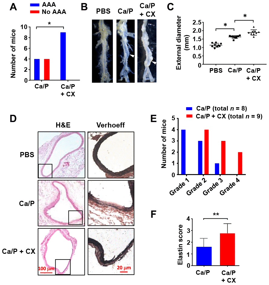 Nucleolar stress induction accelerated AAA formation in vivo. (A) Overall incidences of AAA in CaCl2/phosphate (Ca/P)-treated abdominal aortas in wild type C57BL/6 mice without and with CX-5461 (CX) co-treatment. (B) Gross morphology of Ca/P-induced AAAs (arrowheads) without and with CX-5461 co-treatment. PBS was used as sham control. (C) Dot blots showing the maximal diameter of the abdominal aorta in different groups (n = 8 - 9). (D) Histopathology of Ca/P-induced AAAs without and with CX-5461 co-treatment. The boxes within H&E-stained images indicated the areas shown on the right, which were Verhoeff-Van Gieson-stained high power images. (E) Proportions of AAAs with different severity (graded 1 to 4 with increasing severity) in Ca/P-treated aortas without and with CX-5461 co-treatment. (F) Elastin Scores of Ca/P-induced AAAs without and with CX-5461 co-treatment (n = 8 - 9). Data were expressed as mean ± S.D. Data in C and F were analyzed with one-way ANOVA and unpaired t-test respectively. Data in A were analyzed using χ2 test. * P P 