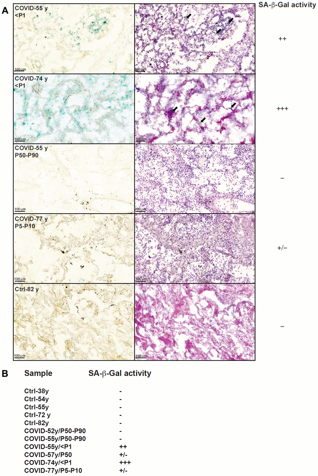 SA-β-Gal staining of lung slices from COVID-19 and control patients. (A) SA-β-Gal staining (left) and HE staining (right) of four COVID-19 lungs and one control lung. We only found signs of senescence (blue staining) in lungs from individuals with very short telomeres (B) overview of detected SA-β-Gal activity within analyzed samples.