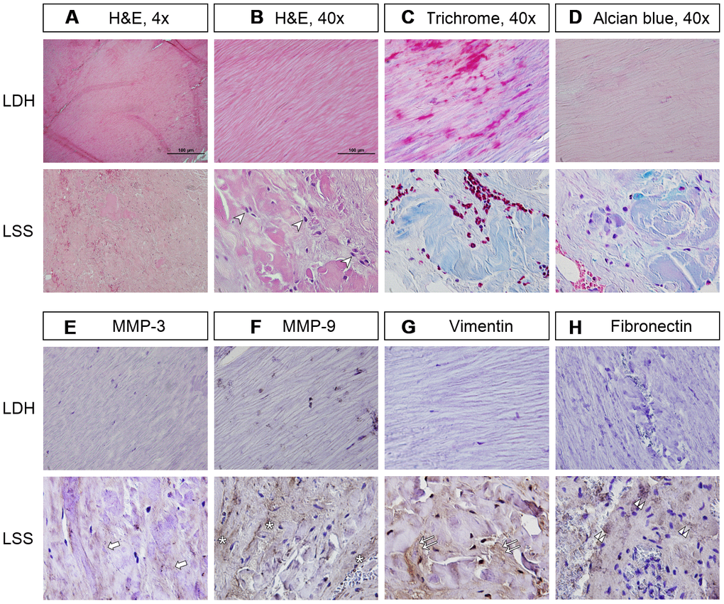 The LF of lumbar spinal stenosis (LSS) patients was positively stained for inflammatory cell infiltration and fibrotic markers. (A, B) In the LF of lumbar disc herniation (LDH) patients, the collagen fibers were well organized in a parallel order. In contrast, those from LSS patients showed signs of inflammation and fibrosis, including infiltration of inflammatory cells (arrowheads) and deposition of disorganized collagen fibers. Scale bar 100μm. (C) Masson’s trichrome staining revealed that the LF from LSS patients was stained a blue color with only traces of pink, further substantiating the increase in collagen deposition. (D) Alcian blue staining of the LF from LSS patients was stained a blue color, indicating increased deposition of glycosaminoglycans. (E, F) Immunohistochemical (IHC) analysis demonstrated that MMP-3 (arrows) and MMP-9 (asterisk) were positively stained on the LF specimens of LSS patients. (G, H) IHC analyses revealed that vimentin (double arrows) and fibronectin (double arrowheads) were positively stained on the LF specimens of LSS patients.