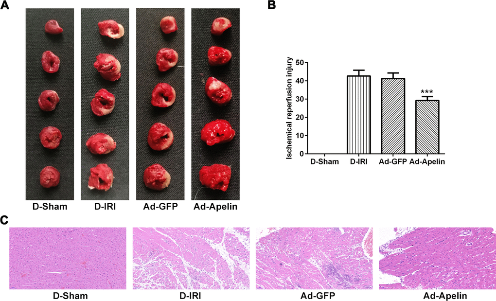 Role of Apelin on cardiac infarction and pathology in cardiac IRI rats. (A, B). The infarction of cardiac was evaluated by TTC staining. ***PC) The pathology of myocardium was assessed by HE staining. Magnification, ×200. TTC: triphenyltetrazoliu chloride; HE: Hematoxylin-eosin; D-Sham: Diabetes sham group; D-IRI: Diabetes ischemia reperfusion injury; Ad-GFP: D-IRI rats injected with Ad-recombined lentiviral vector expressing GFP. Ad-Apelin: D-IRI rats injected with Ad-recombined lentiviral rector expressing Apelin.