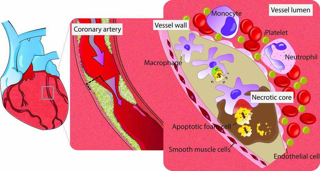 Schematic view of efferocytosis (imbalance between red vs. green area). Red zone, area with defective efferocytosis. Green zone, area with normal efferocytosis. Apoptotic cells in the growing atherosclerotic plaque are not recognized for efficient phagocytic clearance by macrophages. Impaired efferocytosis contributes to development of atherosclerosis. As a result, foam cells accumulate and the lesion expand with subsequent secondary necrosis in the apoptotic tissue. the end product of this cascade is vascular inflammation and instability of the lesion.