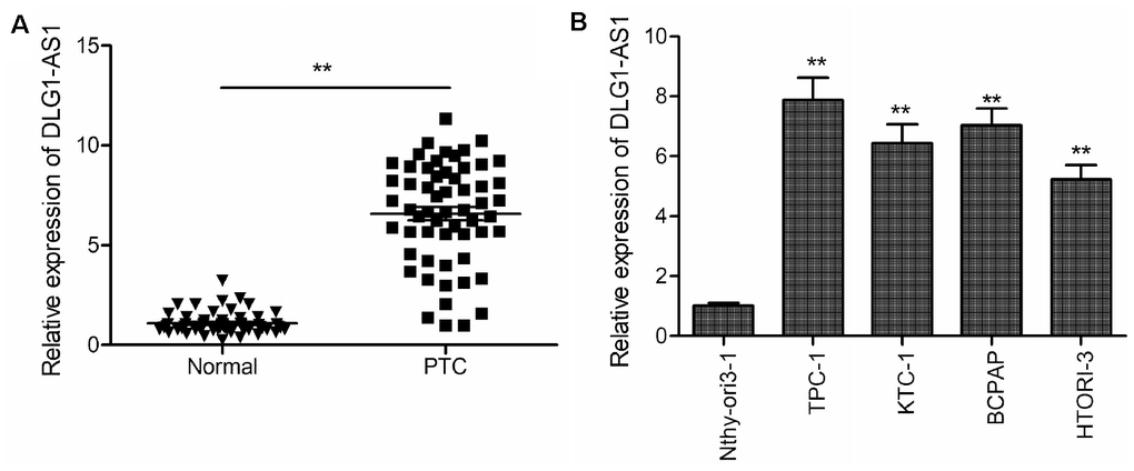 DLG1-AS1 expression is upregulated in PTC tissues and cell lines. (A) Quantitative real-time reverse transcription-polymerase chain reaction (qRT-PCR) assays showing upregulated expression of DLG1-AS1 in PTC tissues as compared with that in adjacent normal tissues. (B) The qRT-PCR assays reveal upregulated expression of DLG1-AS1 in four PTC cell lines as compared with that in a normal thyroid epithelial cell line (Nthy-ori 3-1). All experiments were performed in triplicate, and data are expressed as mean ± standard deviation (SD) (*P P 