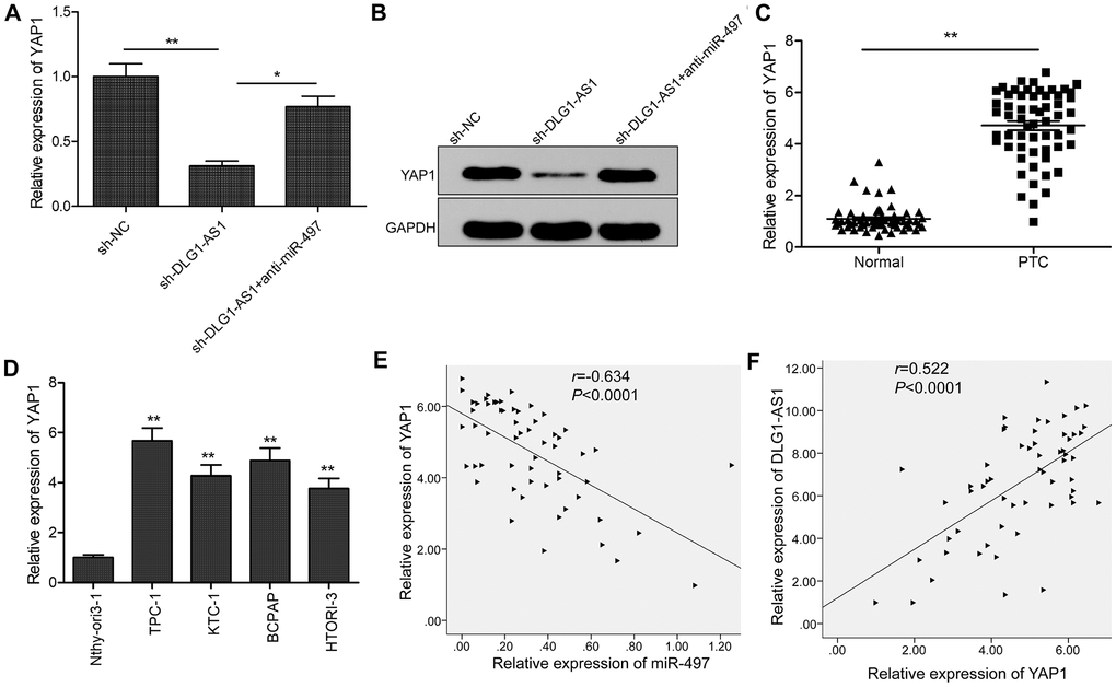 DLG1-AS1 regulates YAP1, the target gene of miR-497 in PTC cells. (A, B) The expression of YAP1 was examined in TPC-1 cells transfected with sh-NC, sh-DLG1-AS1, and sh-DLG1-AS1+miR-497 inhibitor (anti-miR-497). (C) Compared with adjacent normal tissues, the expression of YAP1 increased in PTC tissues. (D) Quantitative real-time polymerase chain reaction (qPCR) assays showing upregulated expression of YAP1 in four PTC cell lines as compared with that in a normal thyroid epithelial cell line (Nthy-ori 3-1). (E) Analysis of correlation between YAP1 and miR-497 expression in PTC tissues by Pearson’s correlation analysis. (F) Analysis of correlation between YAP1 expression and DLG1-AS1 expression in PTC tissues by Pearson’s correlation analysis. All experiments were performed in triplicate, data are expressed as mean ± standard deviation (SD) (*P P 