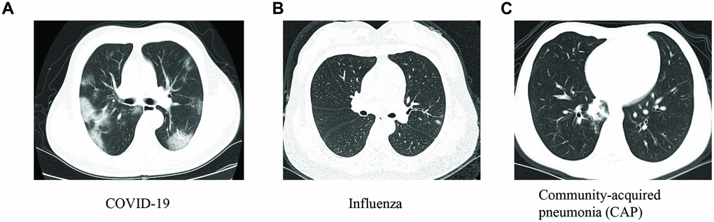 The representative chest images for patients with COVID-19 (A), influenza (B) and community-acquired pneumonia (CAP) (C).