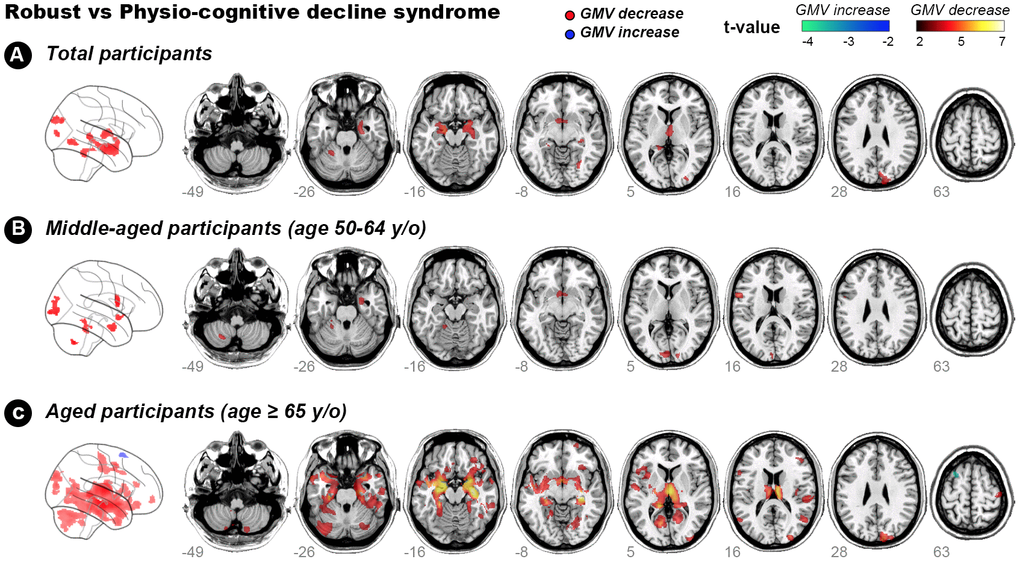 Hot colour map of gray-matter volume-diminished regions in subjects with physio-cognitive decline syndrome. GMV = gray-matter volume; L = left; R = right; PCDS = physio-cognitive decline syndrome.
