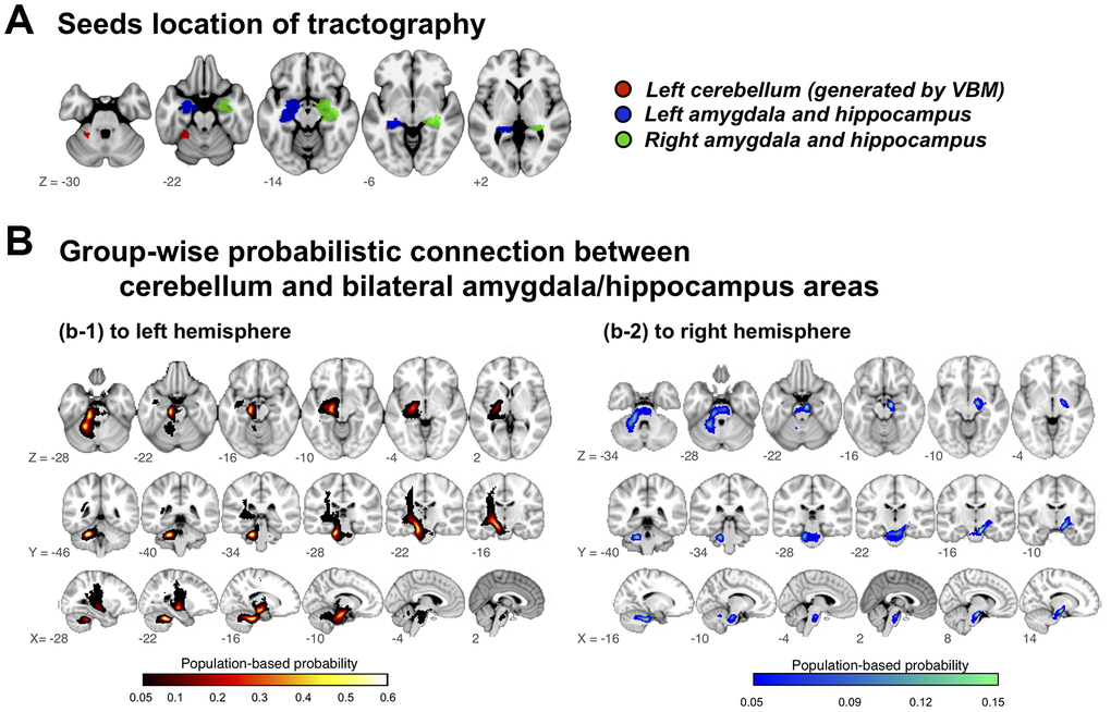 Group-wise probabilistic connections between cerebellar and bilateral amygdala/hippocampus areas. VBM = voxel-based morphometry.