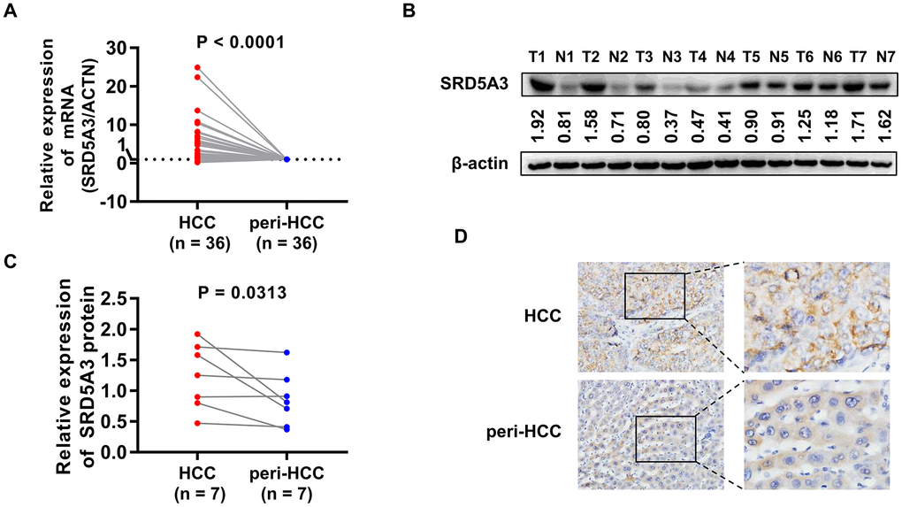 qRT-PCR, Western blot and IHC measurements of SRD5A3 in HCC and peri-HCC tissues. (A) The mRNA expression of SRD5A3 in 36 pairs of HCC and peri-HCC tissues was measured by qRT-PCR analysis. The SRD5A3 mRNA levels of peri-HCC tissues were normalized as ‘1’. (B, C) The protein level of SRD5A3 in 7 pairs of HCC and peri-HCC tissues was analyzed by Western blot. (D) The location of SRD5A3 protein was detected by IHC staining. T, HCC tumor tissue; N, peri-HCC tumor tissue.