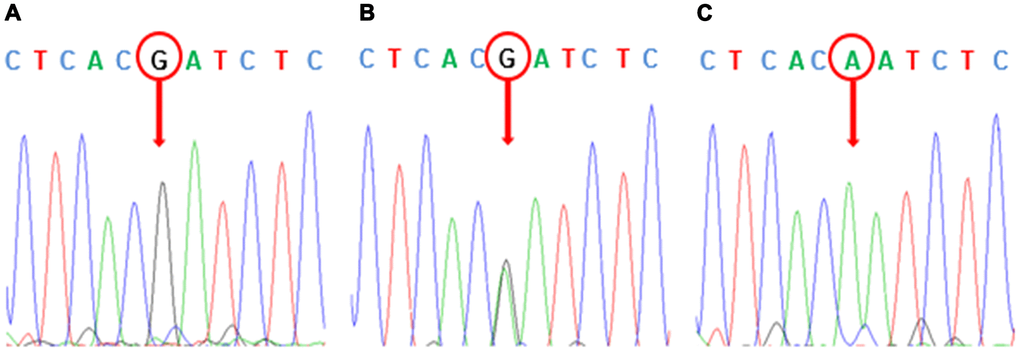 Sequence verification of rs1045642 polymorphism. (A) GG-wild type homozygous. (B) AG-heterozygote. (C) AA-SNP homozygous. The arrow in the picture points to the specific bases of the rs1045642 polymorphic sequence.