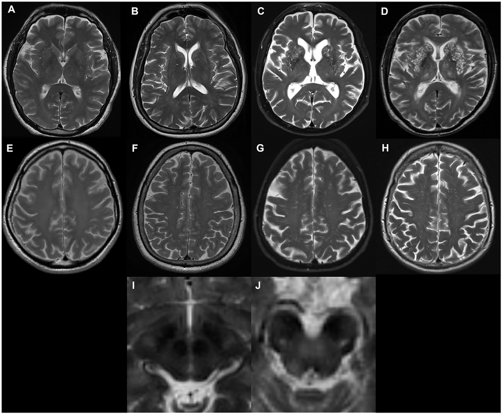 Examples of MRI-visible perivascular spaces. (A–D) Examples of MRI-visible BG-EPVS. (A) grade 1; (B) grade 2; (C) grade 3; (D) grade 4. (E–H) Examples of MRI-visible CSO-EPVS. (E) grade 1; (F) grade 2; (G) grade 3; (H) grade 4. (I) Example of no MRI-visible midbrain-EPVS. (J) Examples of MRI-visible midbrain-EPVS.