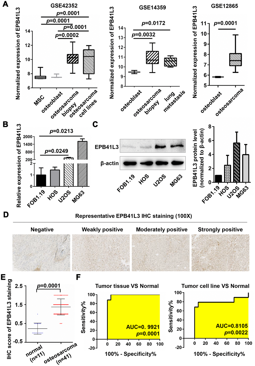 EPB41L3 is up-regulated in osteosarcoma tissues and cell lines. (A) EPB41L3 mRNA expression was significantly higher in osteosarcoma tissues and cell lines than that in normal MSC and osteoblast cells based on data from the Gene Expression Omnibus (GEO accession: GSE42352, GSE14359, and GSE12865). (B) Compared with normal osteoblast cells (hFOB1.19), EPB41L3 mRNA expression was significantly higher in U2OS and MG63 and not obviously up-regulated in HOS as detected by qRT-PCR. GAPDH served as the loading control and was used to normalize the expression data. Data were presented as the mean ± standard error of the mean of two independent experiments. (C) Western blot results showed that EPB41L3 protein expression in U2OS and MG63 but not HOS was significantly higher than that in hFOB1.19 cell. β-actin was used as a loading control and for normalization. Data were presented as the mean ± standard deviation of two independent experiments. (D) IHC staining results of normal bone tissues and osteosarcoma tissues (magnification, x100). (E) IHC total score of EPB41L3 staining was analyzed between normal bone tissues (blue scatter plot, n=11) and osteosarcoma tissues (red scatter plot, n=41). Black solid lines represented the mean ± SD. (F) ROC curves and AUC values for osteosarcoma based on GSE42352. EPB41L3, erythrocyte membrane protein band 4.1-like 3; MSC, mesenchymal stem cell; qRT-PCR, quantitative reverse transcription polymerase chain reaction; GAPDH, glyceraldehyde-3-phosphate dehydrogenase; IHC, immunohistochemistry; ROC, receiver operating characteristic; AUC, area under curve.