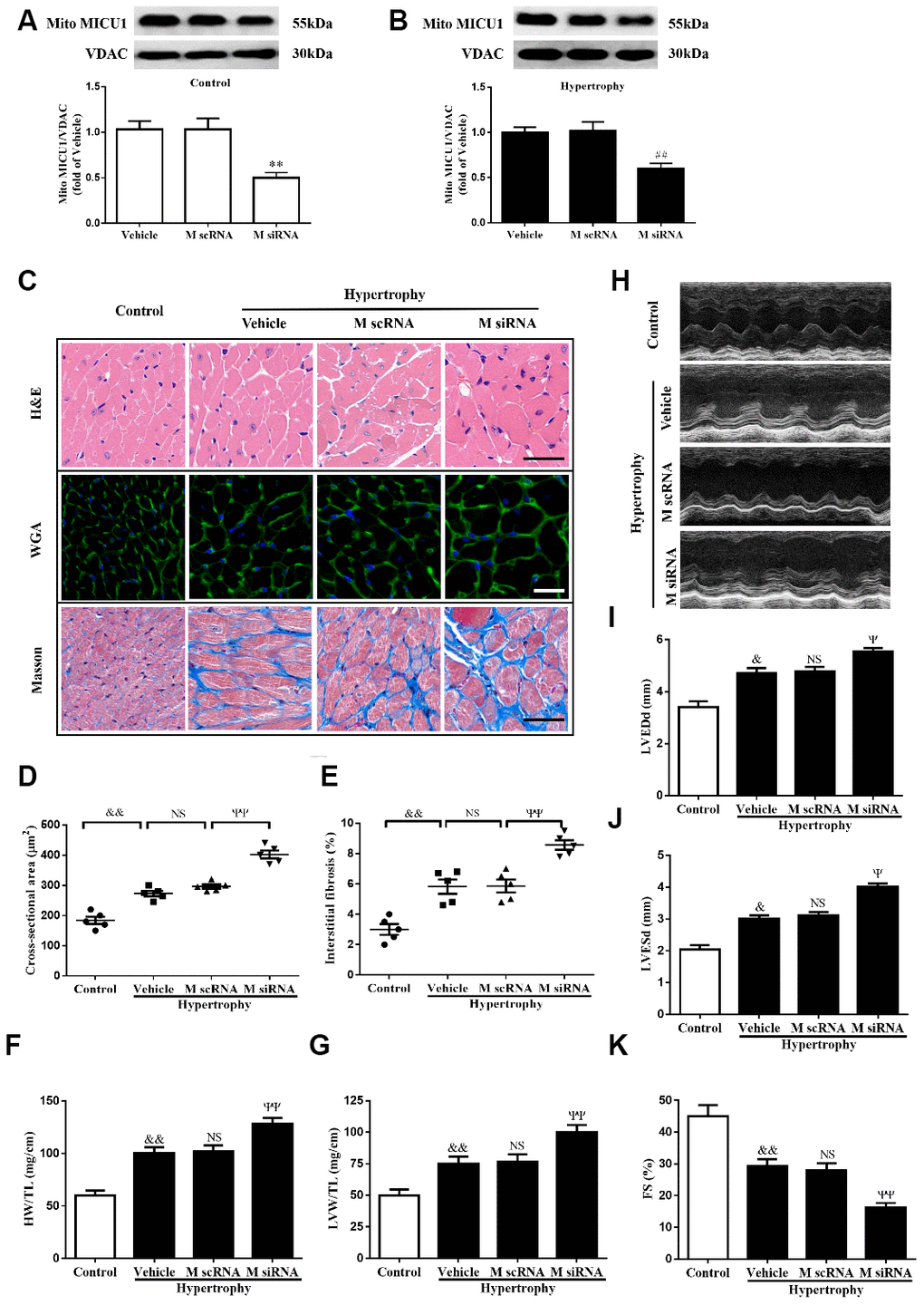 MICU1 downregulation in the heart aggravated Ang-II-induced cardiac hypertrophy. (A) Western blotting was used to measure the transfection efficiency of MICU1 siRNA in control mice. (B) Transfection efficiency of MICU1 siRNA in mice subjected to Ang-II was determined by Western blotting. (C) The heart sections stained with hematoxylin-eosin (H&E, the first row; Scale bars=50 μm), wheat germ agglutinin (WGA, the second row; Scale bars=20 μm) and Masson (the third row; Scale bars=50 μm) from the indicated groups were measured. (D) Cross-sectional cardiomyocyte areas were summarized. (E) The interstitial fibrosis was quantified. (F, G) The ratio of heart weight to tibia length (HW/TL) (F) and left ventricular weight to tibia length (LVW/TL) (G) were determined in different mice. (H) Representative echocardiographic image of the left ventricle in different mice was represented. (I–K) Echocardiographic assessment of left ventricular end-diastolic dimension (LVEDd) (I), left ventricular end-systolic dimension (LVESd) (J) and fractional shortening (FS) (K) was used to reflect cardiac function. M scRNA, scrambled siRNA; M siRNA, MICU1-specific siRNA. All the data represent the means ± SEM. N=6-8/group. **P##P&P&&PΨPΨΨP