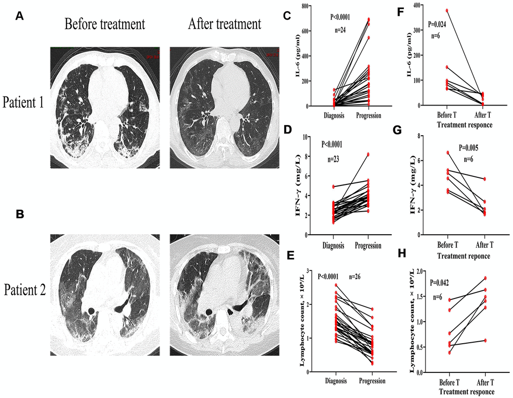 Variation of chest CT images, inflammatory cytokines, and lymphocyte count in severe COVID-19 patients with and without comorbidities. CT images from a 70-year-old male with diabetes showing bilateral lungs before treatment and infiltrating inflammation after one week of treatment. (B) CT images from a 72-year-old female with diabetes and hypertension showing infiltrating inflammation in bilateral lungs before treatment and deteriorated lung inflammation after one week of treatment. (C–E) Serum levels of IL-6 and IFN-γ progressively increased and lymphocytes decreased with disease progression. (F–H) Decreased serum levels of IL-6 and IFN-γ, and recovered lymphocytes before and after glucocorticoid treatment (T).