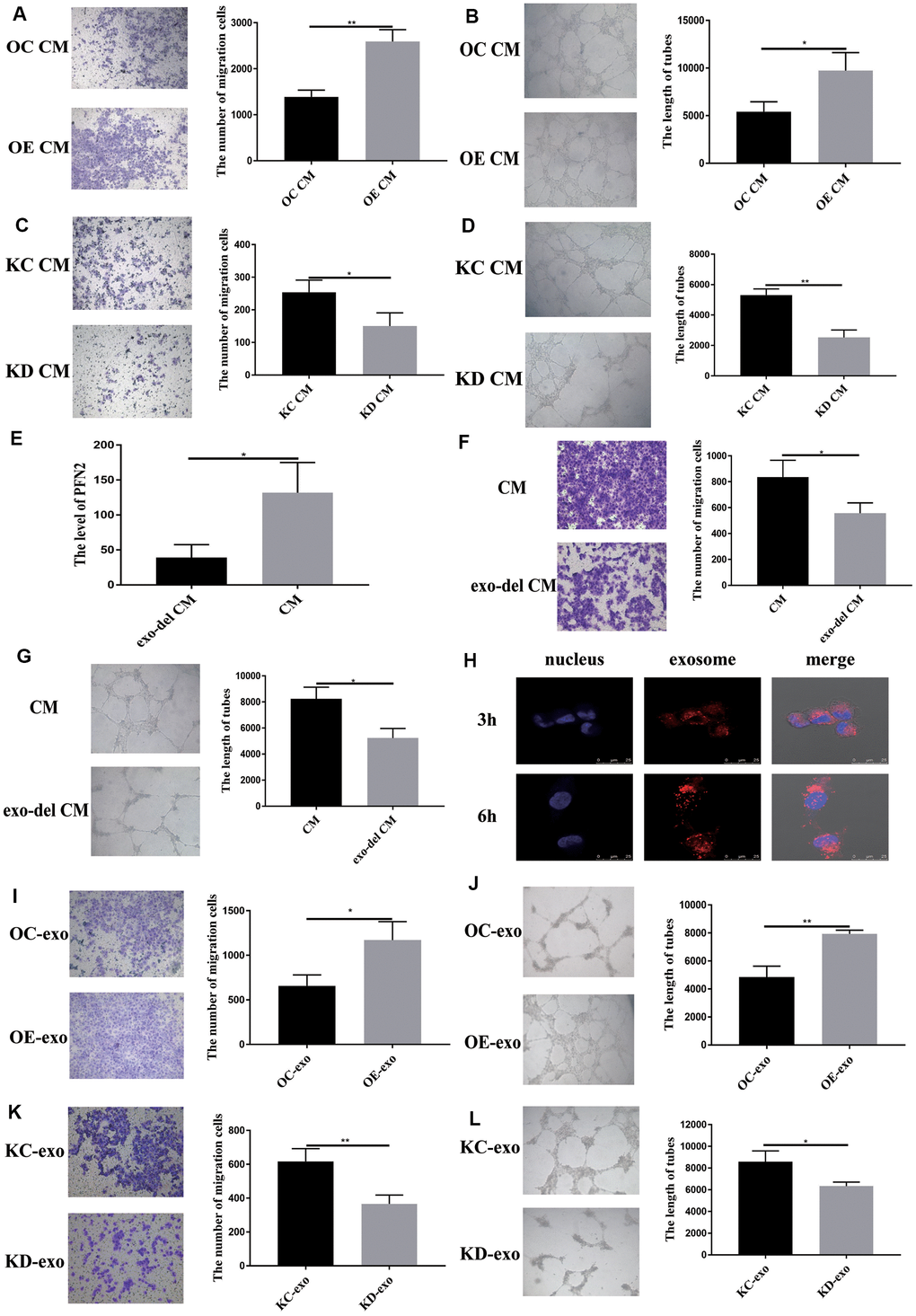 Exosomal PFN2 from H446 cells affect migration and tube formation ability of HUVEC cells. Co-culturing with H446-OE conditioned medium promoted (A) migration (P=0.0022) and (B) tube formation ability (P=0.0255) of HUVEC cells. Co-culturing with H446-KD cells conditioned medium remarkably decreased the migration (P=0.0319) (C) and tube formation ability (P=0.0017) (D) of HUVEC cells. When the exosomes are removed from the CM, PFN2 expression in the CM is significantly decreased (P=0.0267) (E). Exosome depletion from the CM weakens the migration (P=0.035) (F) and tube formation ability (P=0.0112) (G) of HUVEC cells. Exosomes derived from H446 cells could be internalized in HUVEC cells (H). OE-exo elevated the migration (P=0.02) (I) and tube length (P=0.0029) (J) of HUVEC cells. However, KD-exo inhibited the migration (P=0.0093) (K) and tube length (P=0.03) (L) of HUVEC cells.