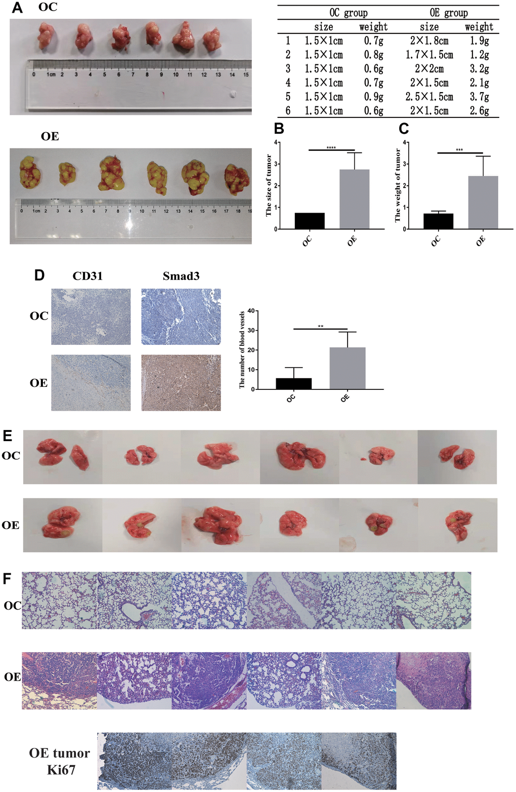 PFN2 promotes tumor growth and metastasis in-vivo. The size and weight of tumor in the H446-OE group is significantly higher than those of tumor in the H446-OC group in xenograft mice model (A–C). There is a significantly higher number of blood vessels in tumor in the H446-OE group than in that in the H446-OC group; meanwhile, Smad3 expression is higher in the H446-OE group than in H446-OC group (D). H446-OE cells could remarkably promote metastasis in vivo (E), confirmed by hematoxylin and eosin staining (F); the number of Ki67 positive cell in metastatic tumor in the lung is significantly higher than that in the adjacent tissues (F).