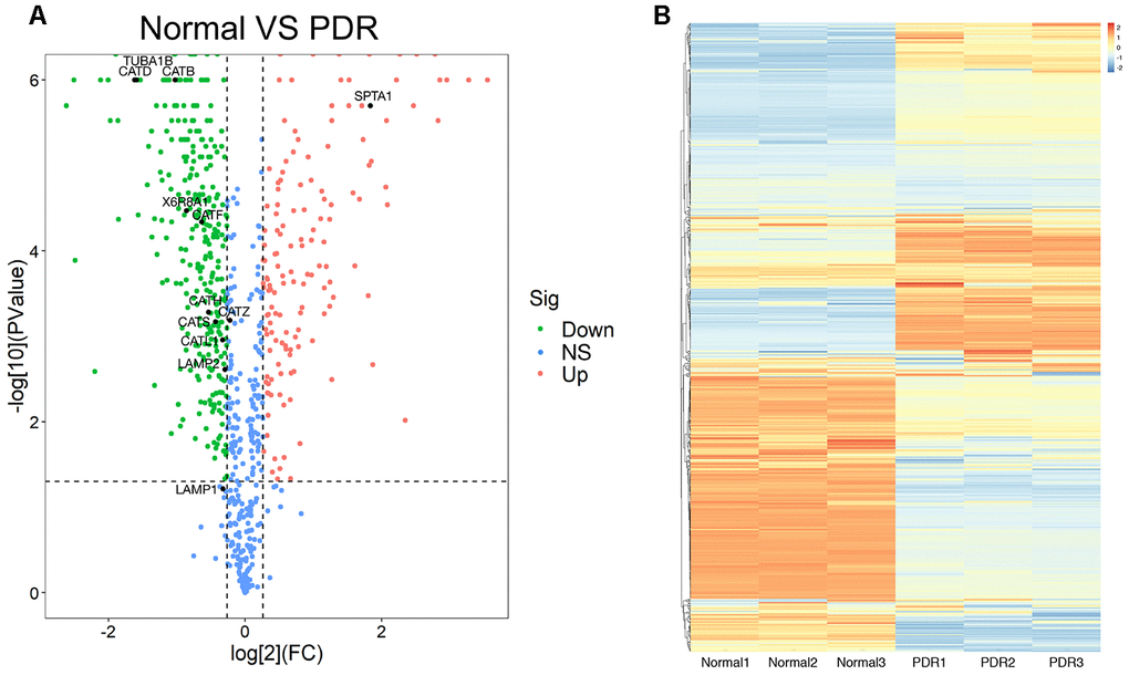 The proteomics analysis of vitreous samples of the patients with RRD and PDR. (A) A volcano map showed the differentially expressed proteins in vitreous samples of RRD and PDR groups (n = 3/group). The blue dots indicate the proteins whose expression was not significantly different between the two groups; the red dots indicate the significantly upregulated proteins in PDR group as compared to RRD group; the green dots refer to the significantly downregulated proteins. The significantly downregulated CTSB, CTSD, and CTSL proteins were designated. (B) Clustering analysis of protein expression in the experimental groups. The color scale on the right illustrated the relative expression levels of proteins in RRD and PDR groups. Red denoted the relative expression level greater than 0 and blue less than 0. RRD: rhegmatogenous retinal detachment; PDR: proliferative diabetic retinopathy; FC: fold change; Sig: significance; Down: downregulation; NS: not significant; Up: upregulation.