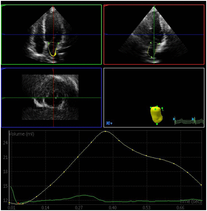 Left atrial volume quantification by RT-3DE of a case in control group.