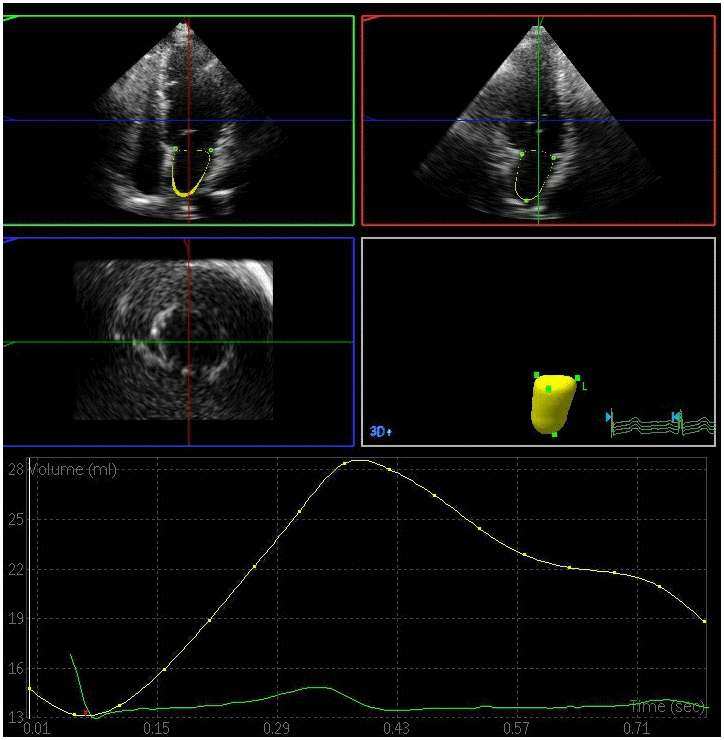 Left atrial volume quantification by RT-3DE of a case in DM group.