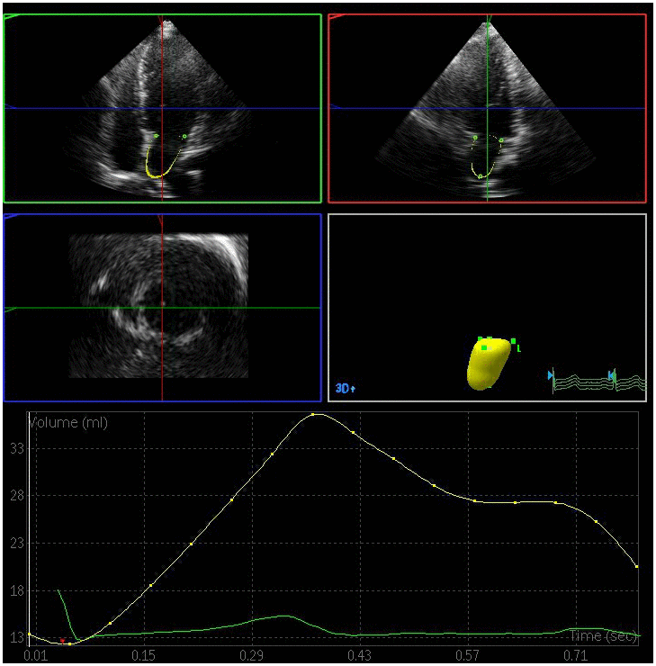 Left atrial volume quantification by RT-3DE of a case in DN group.