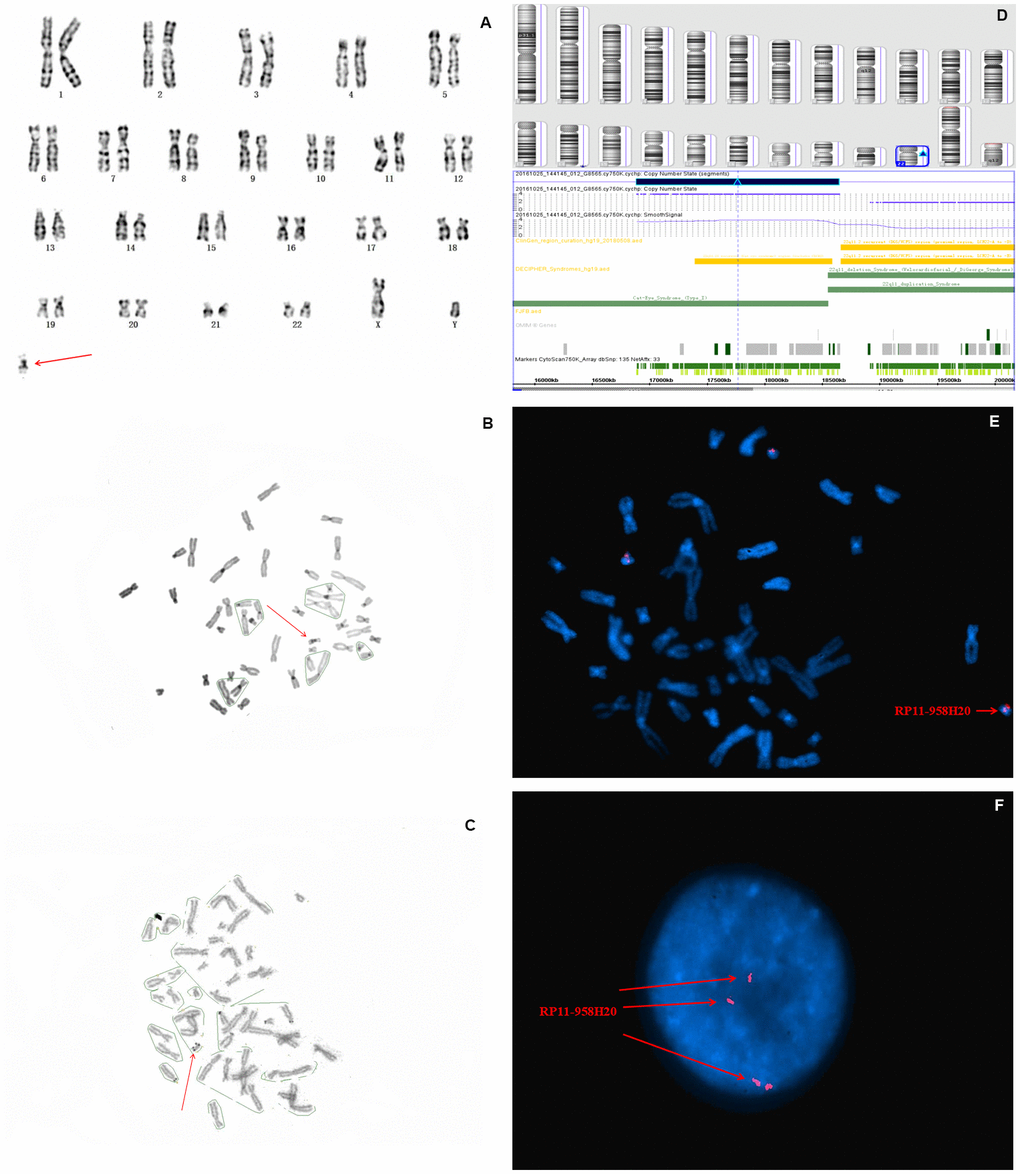 Karyotype, CMA, and FISH analyses results for fetus 1. The red arrow identifies sSMC. (A) G-banding, and (B) C-banding identified the marker as a pseudoisodicentric chromosome. (C) N-banding demonstrated a bisatellited chromosome. (D) SNP array analysis revealed a 1.5 Mb gain in 22q11.1q11.21 with a copy number of four (E) and (F) FISH further clarified that the karyotype of fetus 1 was 47,XY,+mar. ish idic(22)(q11.1q11.2)(RP11-958H20++).