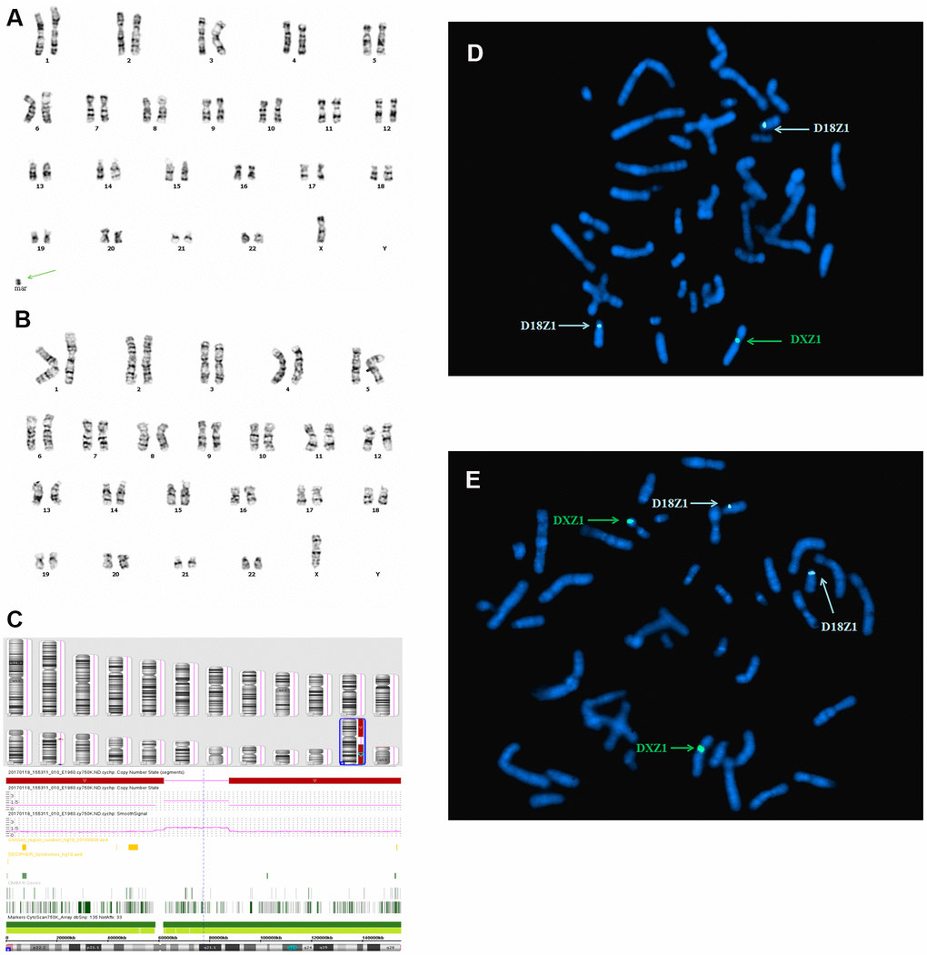 Karyotype, CMA, and FISH analyses results for fetus 2. (A) and (B) a chromosomal karyotyping analysis showed a 45,X mosaic karyotype (46,X,+mar[68]/45,X[32]. The green arrow identifies the sSMC. (A) Karyotype analysis revealed 46,X,+mar. (B) Karyotype analysis revealed 45,X. (C) SNP array analysis revealed a 50 Mb genomic loss at Xp22.33q11.1 (spanning 290 OMIM genes), and a 58 Mb genomic loss at Xq21.31q28 (spanning 296 OMIM genes), including XIST gene. (D, E) Metaphase FISH results using the X, Y, and 18 chromosomal centromeric probes, RB1 and 21S259/D21S341/D21S342 confirmed the karyotype of fetus 2 was 46,X,+mar.ish der(X)r(X)(DXZ1+)[9]/45,X[7].