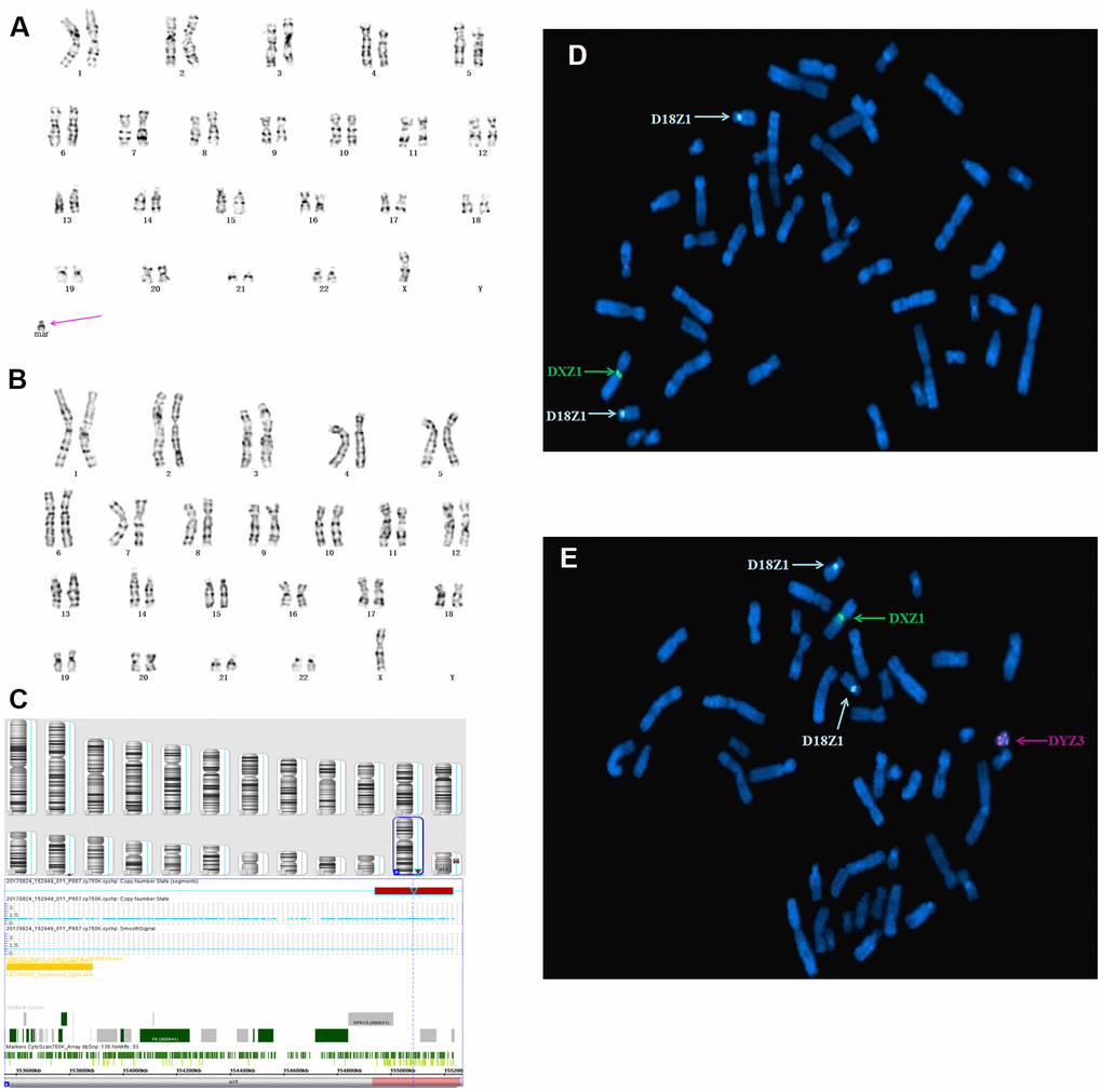 Karyotype, CMA, and FISH analyses results for fetus 3. The purple arrow identifies the sSMC. (A) and (B) conventional karyotype analysis revealed 45,X[62]/46,X,+mar[9]. (C) SNP array analysis revealed a 2.3 Mb genomic gain in Yq11.221q11.222 and a 6.1 Mb genomic loss in q11.222q11.23, spanning 15 OMIM genes, including HSFY1, PRY, DAZ1, AZFb, and AZFc. (D, E) Metaphase FISH analysis using X, Y, and 18 chromosomal centromeric probes revealed the karyotype of fetus 3 to be 45,X(DXZ1×1, DYZ3×0)[22]/46,X,idic(Y)(q11.2?) (DYZ3×2,DXZ1×1)[2]/47,X,idic(Y)(q11.2?)×2(DYZ3×4,DXZ1×1)[1].