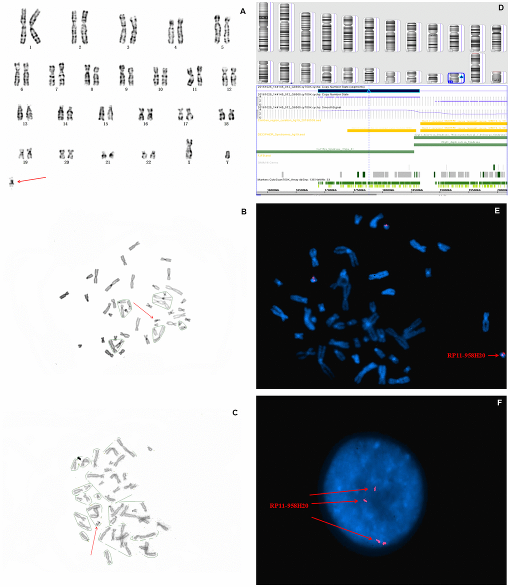 Prenatal diagnosis and molecular cytogenetic identification of