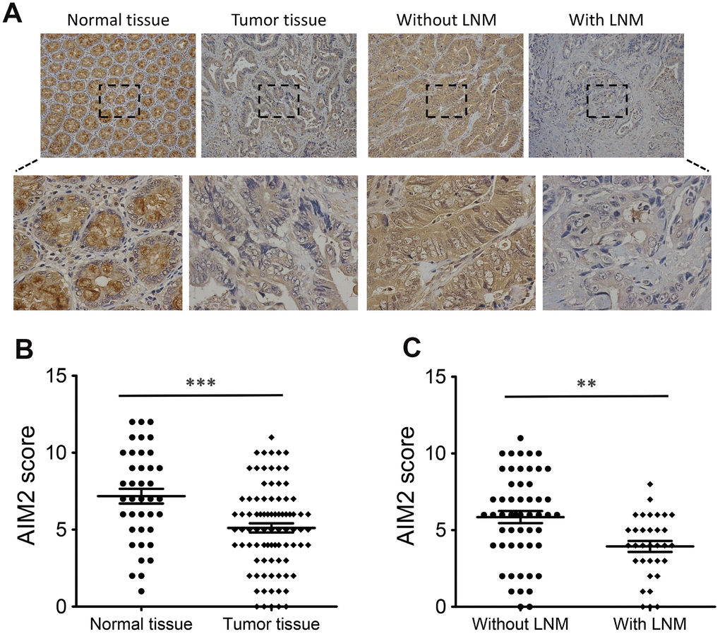 Expression of AIM2 protein in human CRC tissues. (A) IHC staining of AIM2 in CRC tumor tissues and surrounding normal tissues. (B) Scatter plot analysis of AIM2 IHC scores in CRC tumor tissues (n=86) and normal tissues (n=39). (C) Scatter plot analysis of AIM2 IHC scores in CRC tumor tissues with (n=31) or without LNM (n=55). **P
