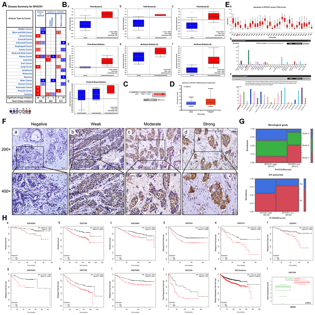 Overexpression of SPOCK1 is positively associated with histological grade, LN metastasis and poor prognosis in BC. (A) The graphic showed the numbers of datasets with statistically significant mRNA high expression (red) or down-expression (blue) of SPOCK1 (cancer vs. Normal tissue). The P-value threshold was 0.01. (B) Box plots derived from gene expression data in Oncomine comparing expression of SPOCK1 in normal and BC tissue. The P-value was set up at 0.01 and fold change was defined as 2. (C) A meta-analysis of SPOCK1 gene expression from seven Oncomine databases where colored squares indicated the median rank for SPOCK1 (vs. Normal tissue) across 7 analyses. (D) The expression of SPOCK1 was elevated in BC compared to normal breast tissues. Data derived from UALCAN database. (E) Expression of SPOCK1 across TCGA carcinomas from Ualcan database (a); overview of SPOCK1 protein levels in BC tissues and normal breast tissues (b-c). (F) IHC staining (negative, weak, moderate and strong expression) for SPOCK1 in BC tissues (a-d). (G) Relationships between SPOCK1 expression and clinicopathologically significant aspects of BC. (H) Overall survival (OS) (a-c), relapse free survival (RFS) (d-i), post progression survival (PPS) (J), distant metastasis free survival (DMFS) (k) and risk assessment curves (l) of patients with or without elevated SPOCK1 levels. Survival data derived from Kaplan–Meier (KM) plotter database. High SPOCK1 expression levels were found in high risk groups of BC patients. Box plots generated by SurvExpress showed the expression levels of SPOCK1 in indicated dataset and the P-value resulting from a t-test. Low-risk groups are denoted in green and high-risk groups in red, respectively.