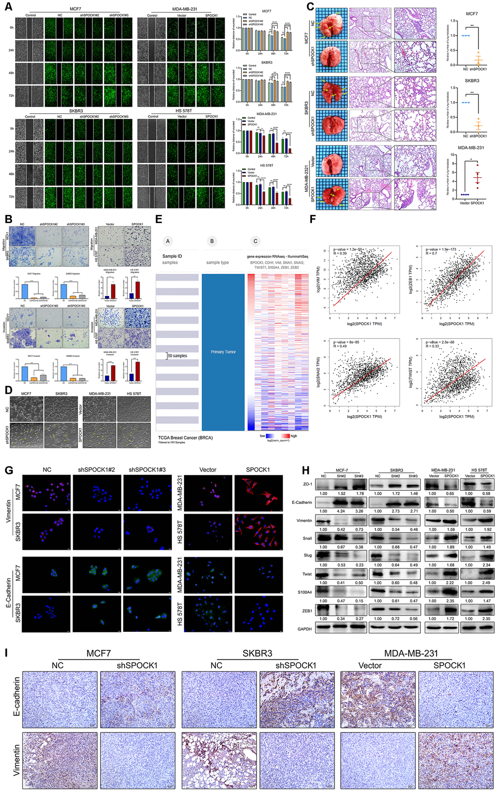 SPOCK1 promotes cellular invasion, metastasis and the EMT in vitro and in vivo. (A) A scratch wound-healing assay was used to determine the effects of SPOCK1 on BC cell motility. (B) Results of a transwell migration assay (a) and a Matrigel invasion assay (b) for cellular invasion. The mean number of cells in five fields per membrane is shown (×200). (C) Representative images of gross and hematoxylin and eosin (H&E) staining and relative numbers of lung surface metastatic foci detected in each group (*PD) Representative images showing the morphological changes in the indicated cell lines. (E) The heat maps of the correlation between SPOCK1 and EMT markers in the same cohort. (F) Positive relationships for SPOCK1 and EMT markers were showed on GEPIA2. (G) The expression of EMT markers was detected by immunofluorescence staining in BC cells. The scale bar is 20 μM. (H) The expression of epithelial markers (E-cadherin and ZO-1) and mesenchymal markers (Vimentin, Snail, Slug, Twist, S100A4 and ZEB1) was determined by western blot analysis. GAPDH was used as a loading control. (I) IHC staining for E-cadherin and Vimentin protein in tumor specimens from xenografts (200×). The P values were obtained using Mann-Whitney U tests or t-tests (*PPPP