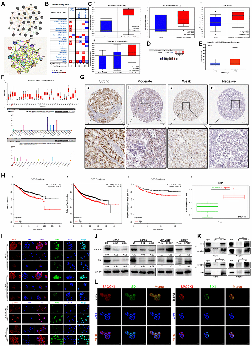 Identification of SIX1 as a downstream mediator of SPOCK1 in BC cells. (A) Network diagram of SPOCK1/SIX1 protein interaction by GeneMANIA (a) and STRING (b). (B) The graphic showed the numbers of datasets with statistically significant mRNA high expression (red) or down-expression (blue) of SIX1 (cancer vs. Normal tissue). The P-value threshold was 0.01. (C) Box plots derived from gene expression data in Oncomine comparing expression of SIX1 in normal and BC tissue. The p value was set up at 0.01 and fold change was defined as 2. (D) A meta-analysis of SIX1 gene expression from four Oncomine databases where colored squares indicated the median rank for SIX1 (vs. Normal tissue) across 4 analyses. (E) The expression of SIX1 was elevated in BC compared to normal breast tissues. Data derived from UALCAN database. (F) Expression of SIX1 across TCGA carcinomas from Ualcan database (a); overview of SIX1 protein levels in BC tissues and normal breast tissues (b-c). (G) IHC staining (negative, weak, moderate and strong expression) for SIX1 in BC tissues (a-d). Data derived from HPA database. (H) Overall survival (OS) (a), relapse free survival (RFS) (b) and distant metastasis free survival (DMFS) (c) curves of patients with or without elevated SIX1 levels. Data derived from Kaplan–Meier (KM) plotter database. High SIX1 expression levels were found in high risk groups of BC patients (d). Data derived from SurvExpress database. (I, J) Expression levels of indicating cells were assayed by IF and western blotting. GAPDH was used as an internal control. (K) The interaction between endogenous SPOCK1 and SIX1 proteins was analyzed by coimmunoprecipitation in MCF7 and SKBR3 cells. (L) Immunofluorescence double-labeling experiments confirmed the existence of SPOCK1-SIX1 colocalization phenomena in the cytoplasm. The scale bar is 20 μM.