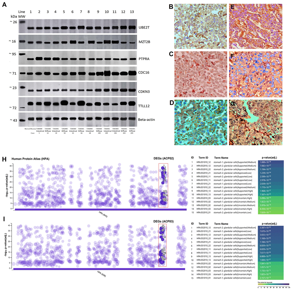 Analysis of protein expression and immunohistochemistry in gastric cancer subtypes. (A) Representative image of Western-blot. Line 1 represents normal gastric tissue and the intensity of the genes are similar to early TNM stages and without metastasis, but much lower than advanced TNM stages (T3/T4). Initial stages with metastasis also have an intensity much higher than that of normal gastric tissue. (B) Positive TTLL12 cytoplasmatic immunostaining in diffuse-type gastric cancer (case 66 T2N3M1); (C) Positive CDC16 cytoplasmic and nuclear immunostaining in diffuse-type gastric cancer (case 140 T3N3M0); (D) Positive CDKN3 cytoplasmatic immunostaining in diffuse-type gastric cancer (case 203 T4N2M1); (E) Positive PTPRA cytoplasmatic immunostaining in intestinal-type gastric cancer (case 5 T1N0M0); (F) Positive MZT2B cytoplasmatic immunostaining in intestinal-type gastric cancer (case 61 T2N3M0); (G) Positive UBE2T cytoplasmatic and nuclear immunostaining in intestinal-type gastric cancer (case 149 T3N3M1) (magnification x40). The differences in band intensity and intensity of immunoreactivity are due to the different stages of TNM in tumor samples of diffuse and intestinal histological types that represent figures (3A, 3B–3G). (H and I) The function of the DEGs in the gastric lines showed a strong correlation between the increased level of protein expression with the human stomach cells in the data from The Human Protein Atlas (HPA) that were accessed and normalized in -log10p-value (adj.). The levels of protein expression of the DEGs are identified by the red rectangle in 15 subtypes of human stomach cells.