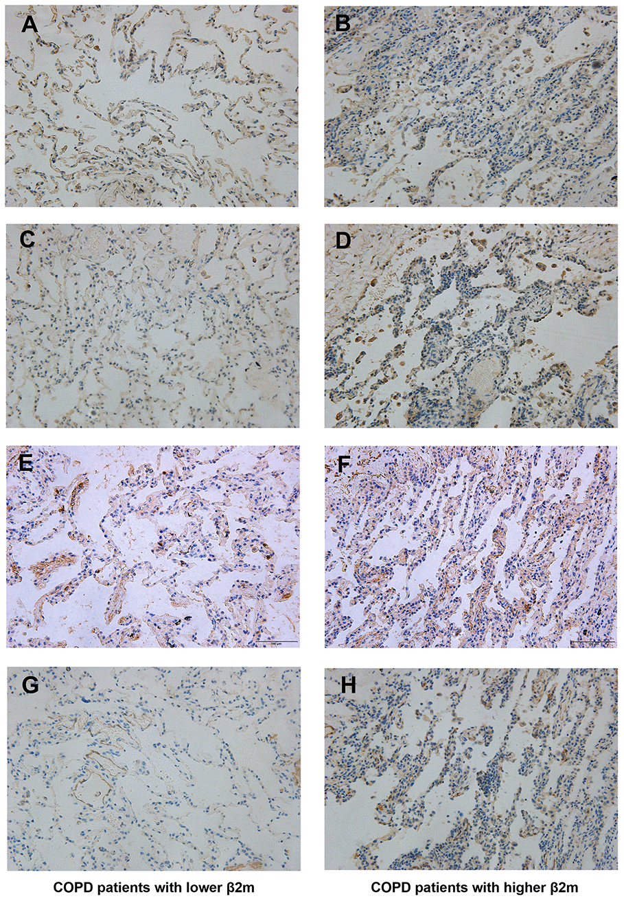 Immunohistochemical staining of lung tissue from COPD patients. Lung tissue of COPD patients with lower serum β2M including (A, C, E, G); lung tissue of COPD patients with higher serum β2M including (B, D, F, H). Indicators and positive cell rate: (A, B) Representative image of β2M immunohistochemical staining of lung tissue from COPD patients with lower serum β2M (17.17 ± 1.64%) and with higher serum β2M (28.95 ± 1.26%) respectively. (C, D) Representative image of TGF-β1 immunohistochemical staining of lung tissue from COPD patients with lower serum β2M (16.48 ± 0.63%) and with higher serum β2M (32.46 ± 0.69%) respectively. (E, F) Representative image of Smad4 immunohistochemical staining of lung tissue from COPD patients with lower serum β2M (34.95 ± 0.71%) and with higher serum β2M (43.38 ± 0.90%) respectively. (G, H) Representative image of a-SMA immunohistochemical staining of lung tissue from COPD patients with lower serum β2M (3.854 ± 0.43%) and with higher serum β2M (26.66 ± 0.89%) respectively. P